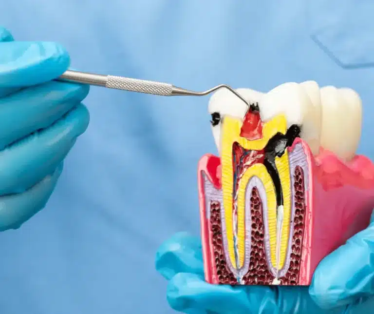 Complications Of Root Canal Re-Treatment root canal treatment london 2