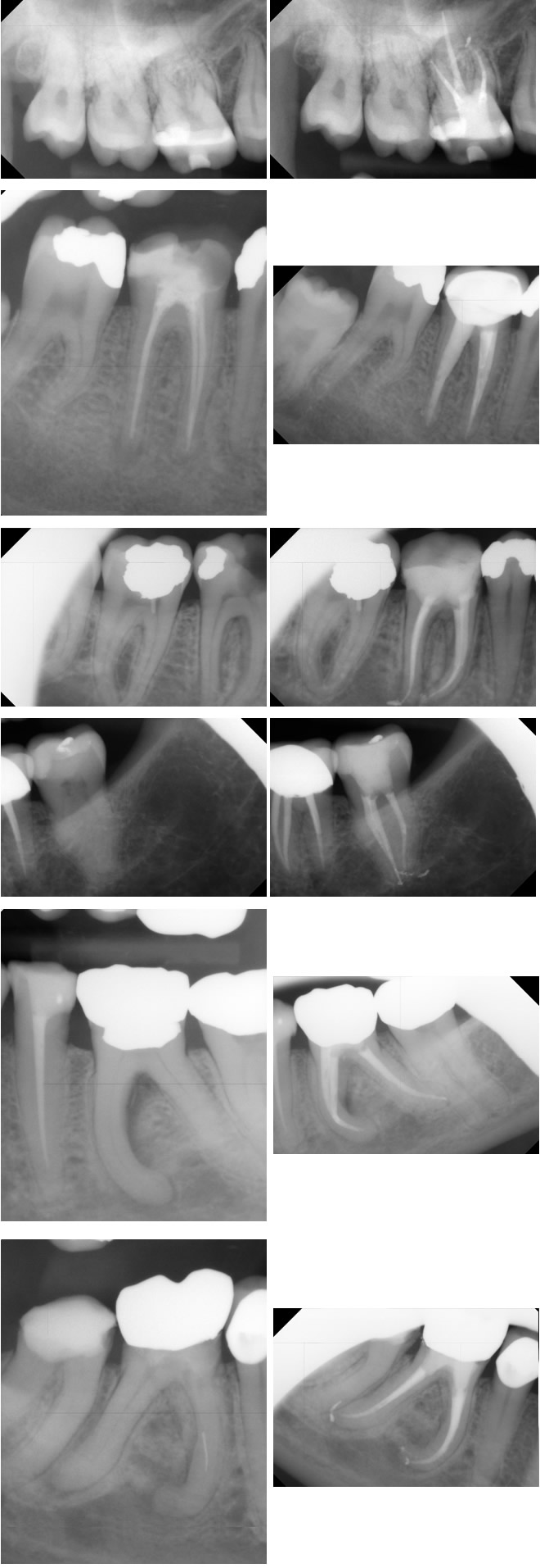 X ray of root canal