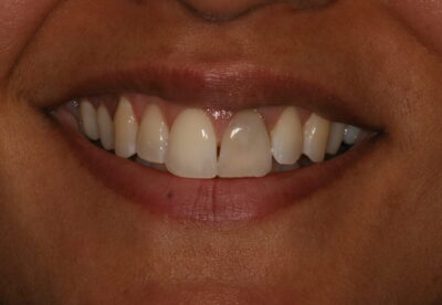 implant_london_before
