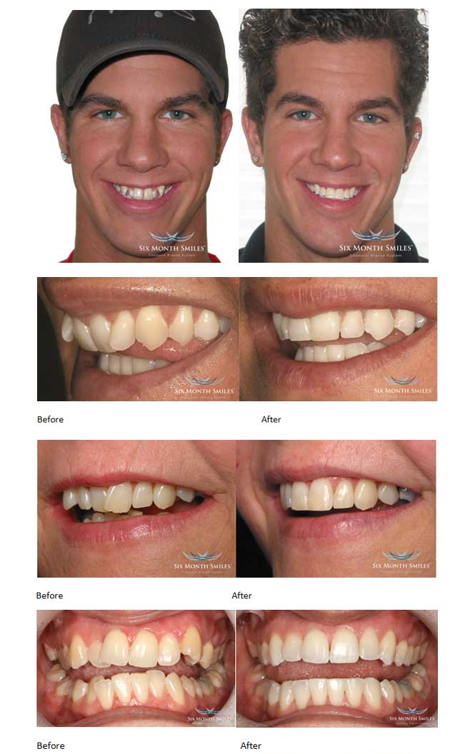 Six Month Smiles Before and After