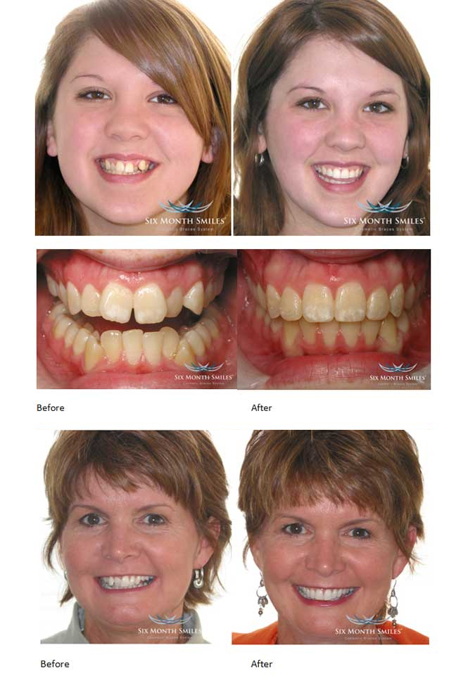 Before and After Six Month Smiles