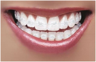 Six month smiles deals