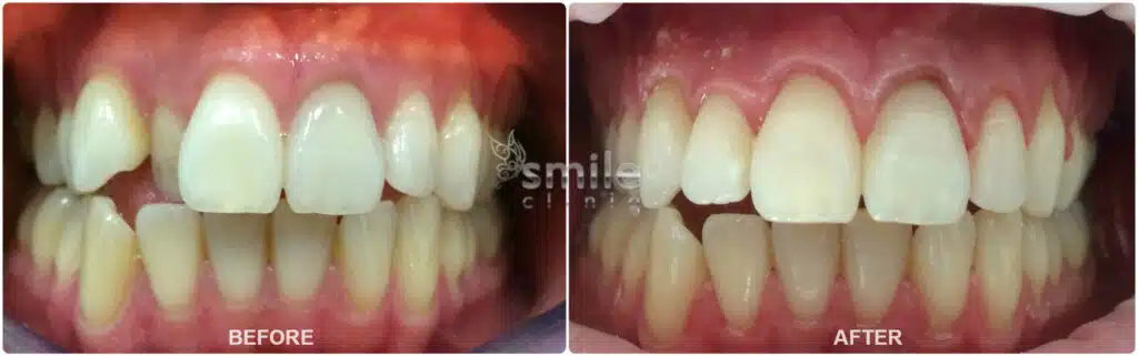 Before and after professional teeth whitening, showing dull teeth transformed into a bright, even smile.