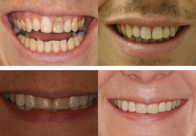 Porcelain veneers Before and After