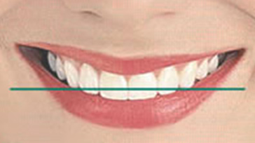 Horizontal smile line