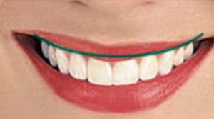 Gingival (gum) Line