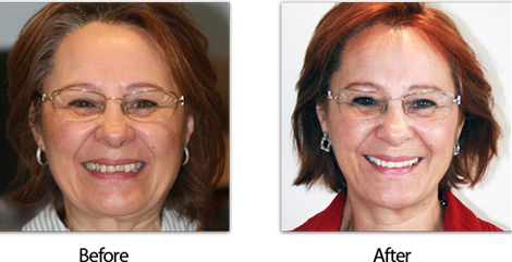 Dentures Meaning British  . Here Are All The Possible Meanings And Translations Of The Word Dentures.