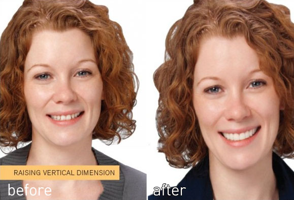 Before an after having Snap on Smile