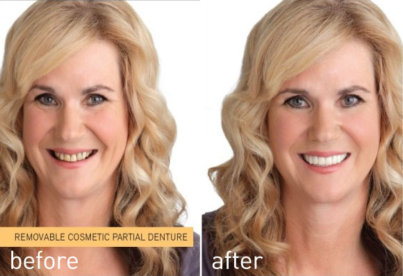 Before an after having Snap on Smile - Removable cosmetic partial denture
