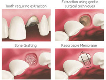 Socket preservation
