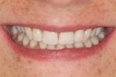 Teeth After Inman Aligners 