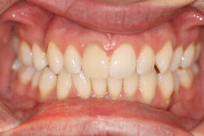 Tooth Whitening Treatment After