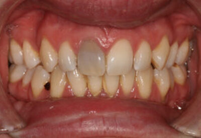 Tooth Whitening Treatment Before