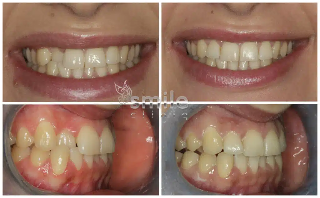Before and after: Crooked teeth corrected to a bright, aligned smile.