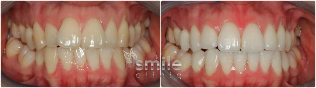Before And After Teeth Whitening Treatment Results At Smile Cliniq Showing A Brighter, Whiter Smile before and after teeth whitening treatment results at smile cliniq showing a brighter, whiter smile