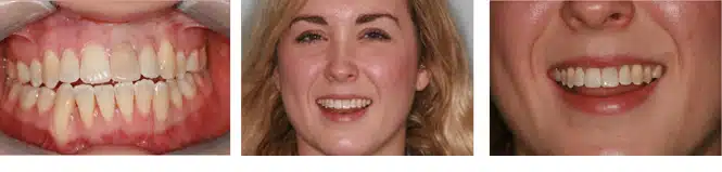 dark tooth treatment patient story