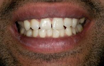 tooth_whitening_london_after