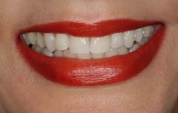 tooth_whitening_london_after