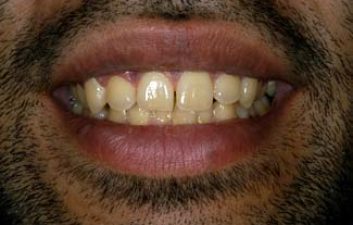 tooth_whitening_london_before