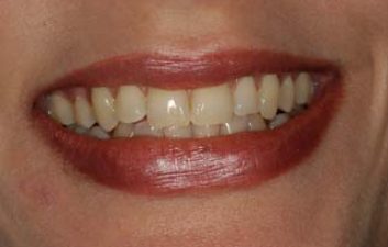 tooth_whitening_london_before