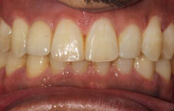 Smile after implants