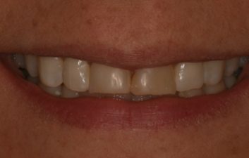 veneers_london_before