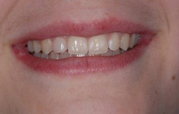 White fillings London after