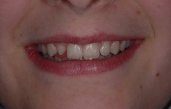 White fillings London before