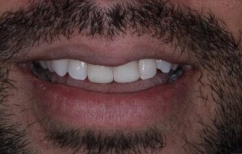 whitening and cosmetic bonding after