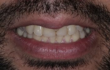 whitening and cosmetic bonding before