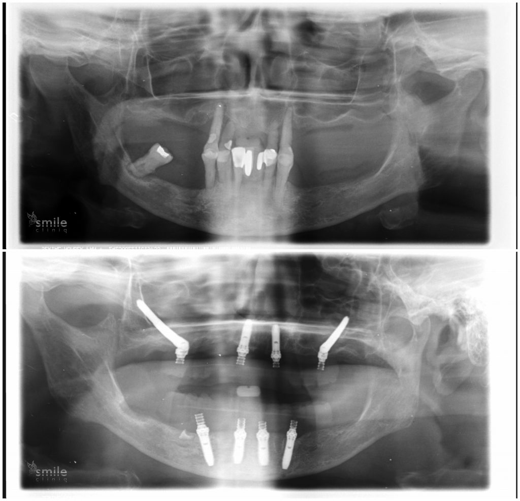 X-ray of Zygomatic Arch Implants 