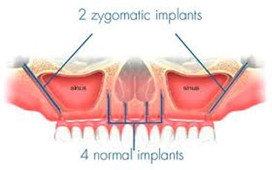 Zygomatic Arch Implants