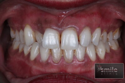 dark gums lasering after london dentist