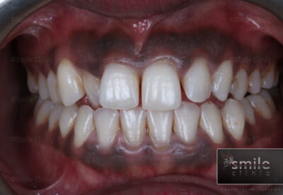dark gums lasering before london dentist