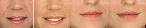 Dermal filler treatment