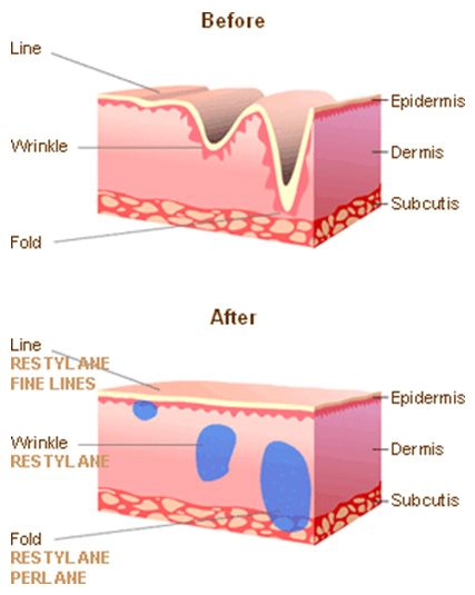 Before and After Restylane