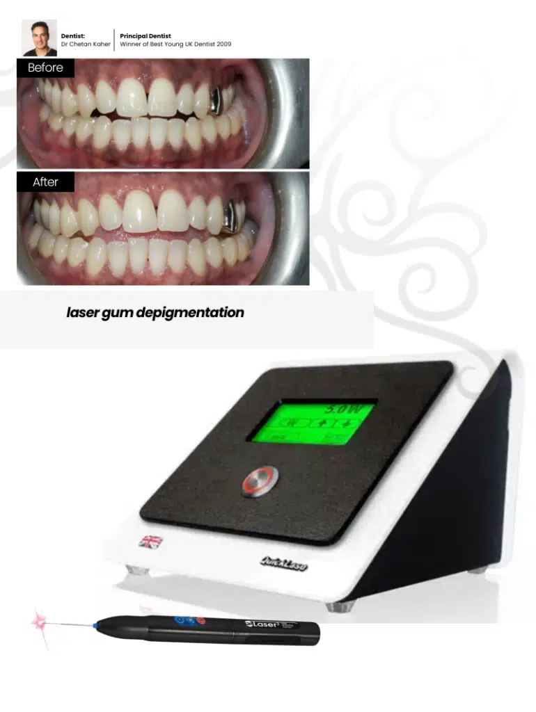 laser gum depigmenetion treamnet in London