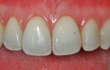 London Pinhole gum treatment after