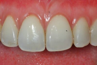 London Pinhole gum treatment after