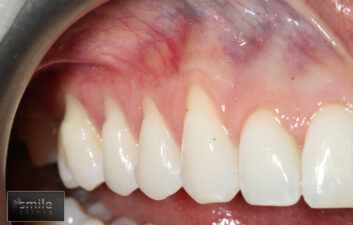 before same day gum surgery london