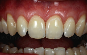 London dentist receeding gums treatment after