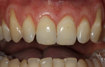 London dentist receeding gums treatment before