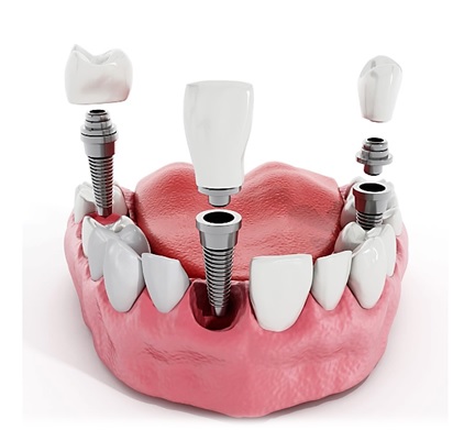 Loose implant crown causing dental pain