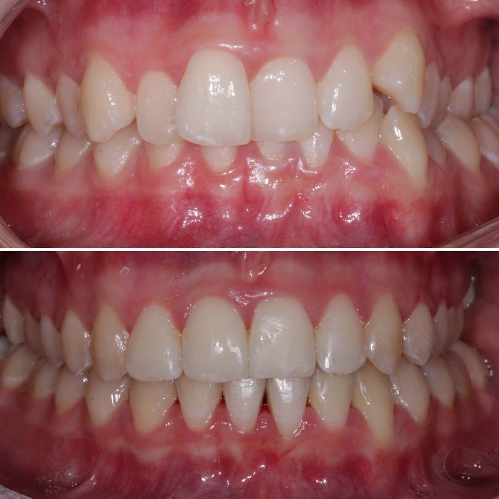 Fast braces - before and after