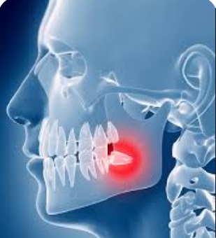 Wisdom tooth dental pain at the back of the mouth