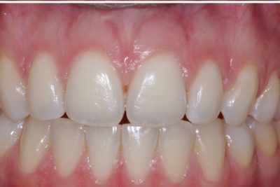 After - Diastema/Space Closure