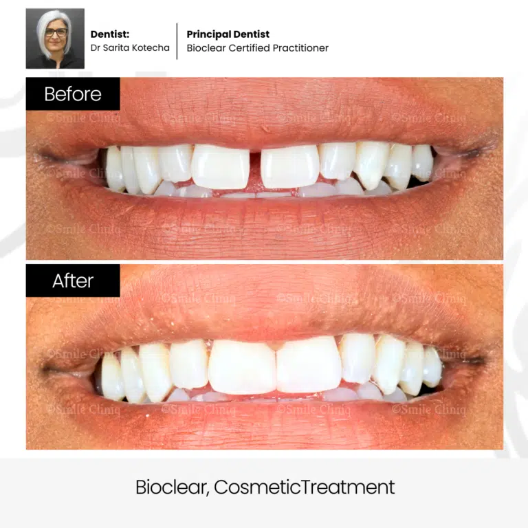 Diastema Closure London, Book A Consultation Online Now