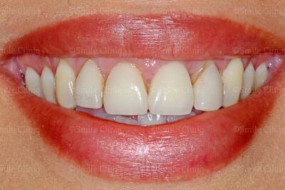 How to Fill Gaps Between Teeth: Your Guide to Diastema