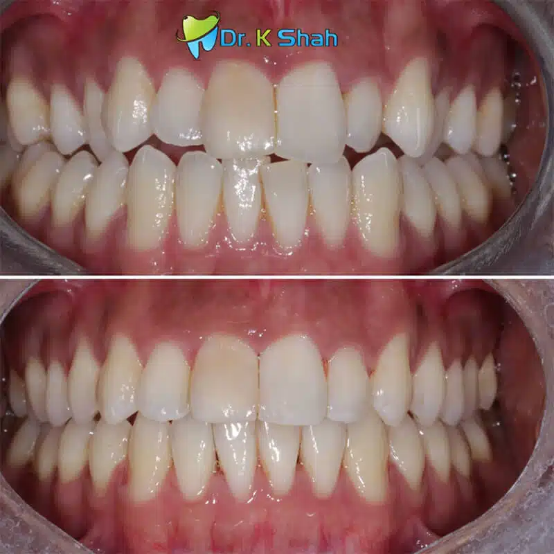 Before and after dental treatment correcting a crossbite, crowding, and an edge-to-edge bite.