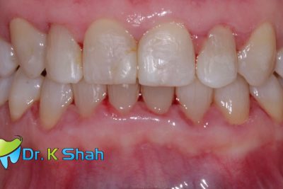 After - Deep Bite and high canine correction